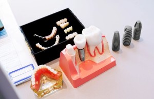 宁波种牙哪家医院好，宁波鼎植口腔医院口碑更好