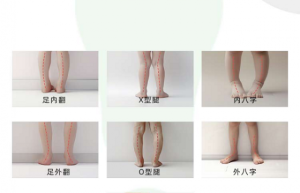 芯迈儿童步态调整与纠正解决方案