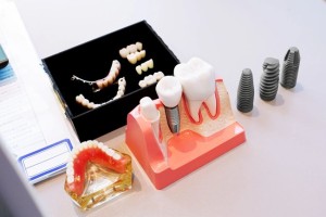 宁波种牙哪家医院好，宁波鼎植口腔医院口碑更好